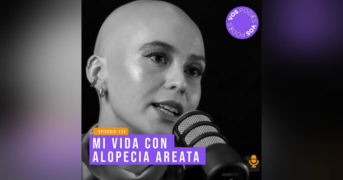 Mi vida con alopecia areata - invitada Mafe Benitez