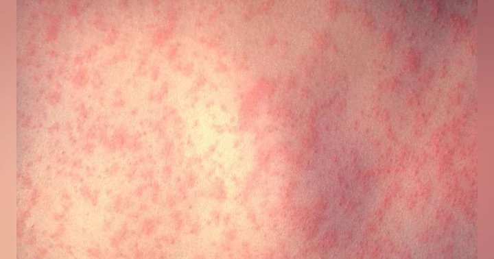 image for Why We Should Vaccinate Against Measles