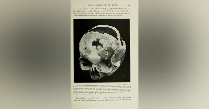 image for Understanding the Alarming Increase in Syphilis and Other STIs