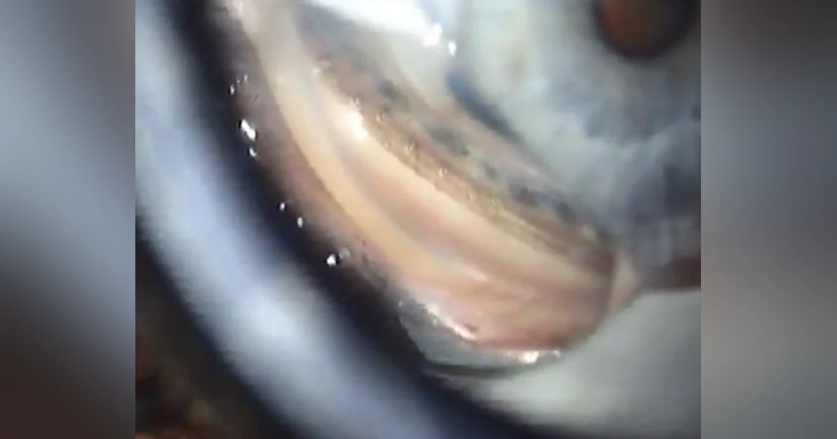 Ep 20 Talking About Glaucoma - 3Jan2013: Excimer Laser Trabeculostomy (mp3 version)