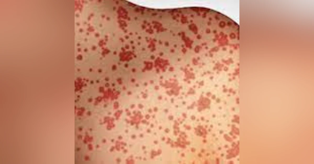 S3 E8: Minor Childhood Disease: The Story of Measles