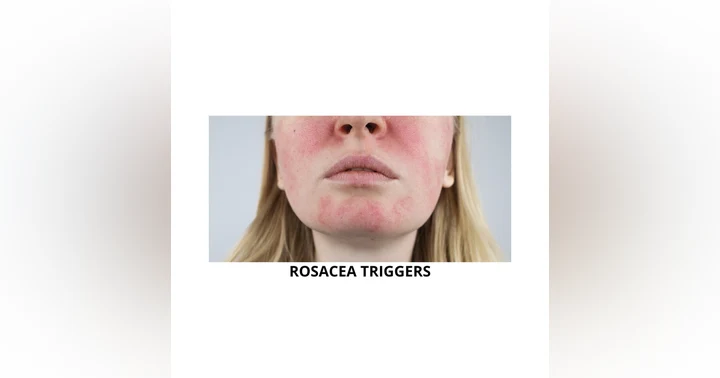 image for Rosacea Triggers Explained: What Causes Flushing, Redness, and How to Calm Sensitive Skin