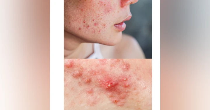 image for Acne Myths vs. Facts: What Dermatologists and Estheticians Want You to Know About Clearer Skin