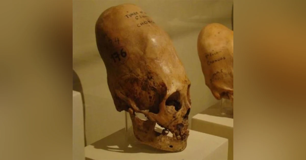 Elongated Skulls: Human or Alien?