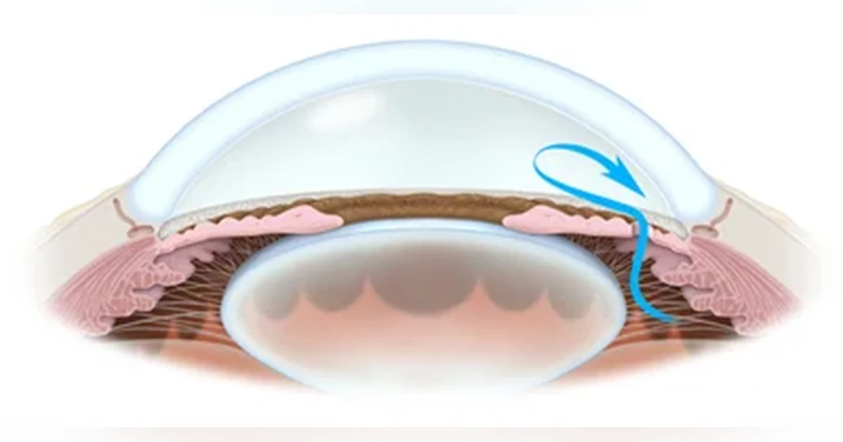 Ep 21 Talking About Glaucoma - 26Feb2013: Laser Iridotomy (mp3 version)