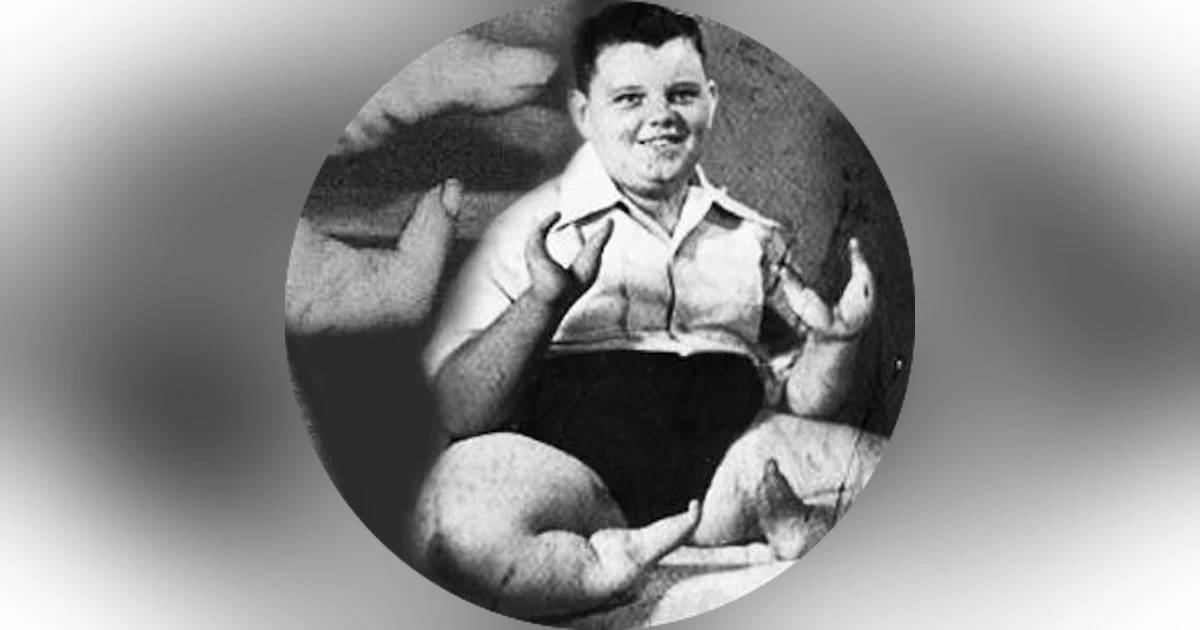 62. Lobster Boy - Grady Stiles, Jr.