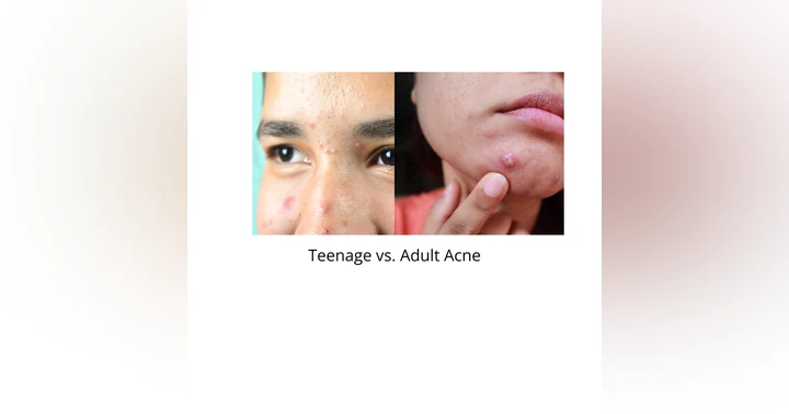 image for Teenage vs Adult Acne: Key Differences, Causes, and Treatment Strategies Explained