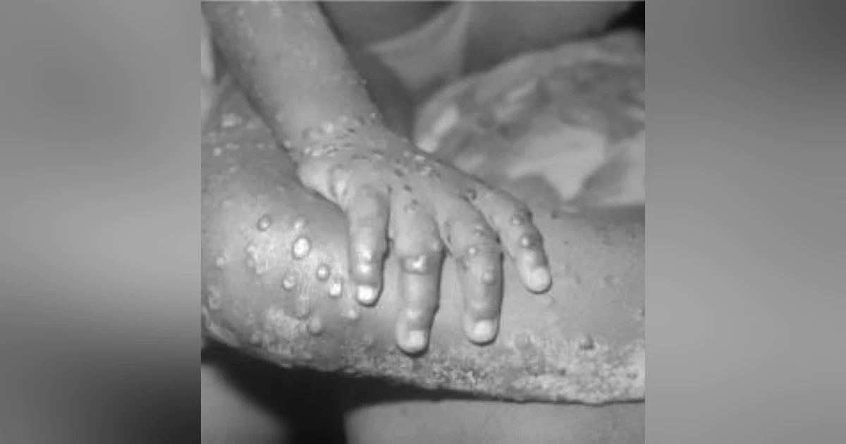 S3 E15: More Than You Ever Wanted to Know: Monkeypox: Q&A