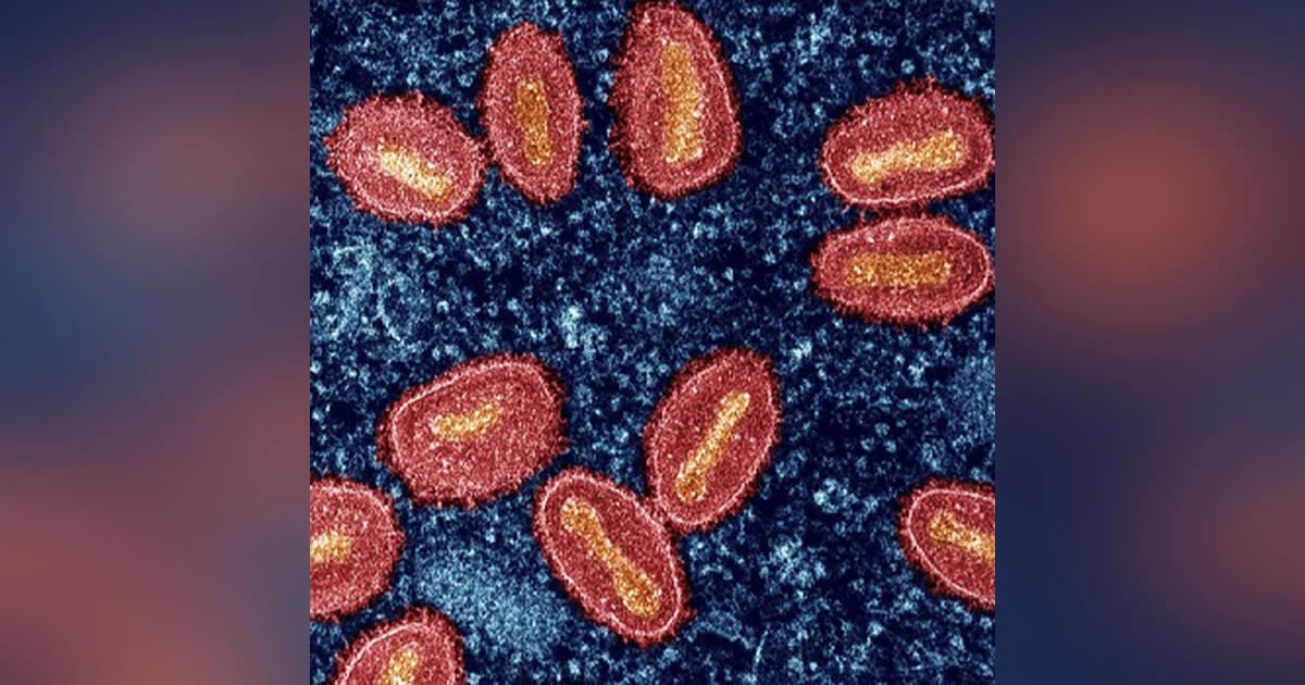 Mpox Outbreak in Sweden Raises Concerns of Wider Spread in Europe