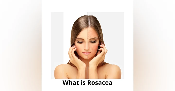 image for Rosacea Explained: Symptoms, Triggers, Diagnosis, and Effective Treatment Options