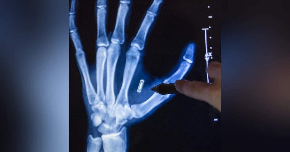 The Invisible Crime: Illegal Microchip Implants and Microwave Technology