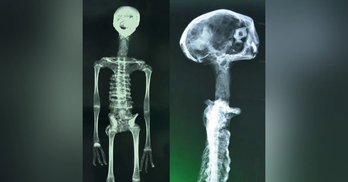 Peruvian Alien Mummies: Paracas Skulls, Starchild Skull, and The Dark Ages of Ufology