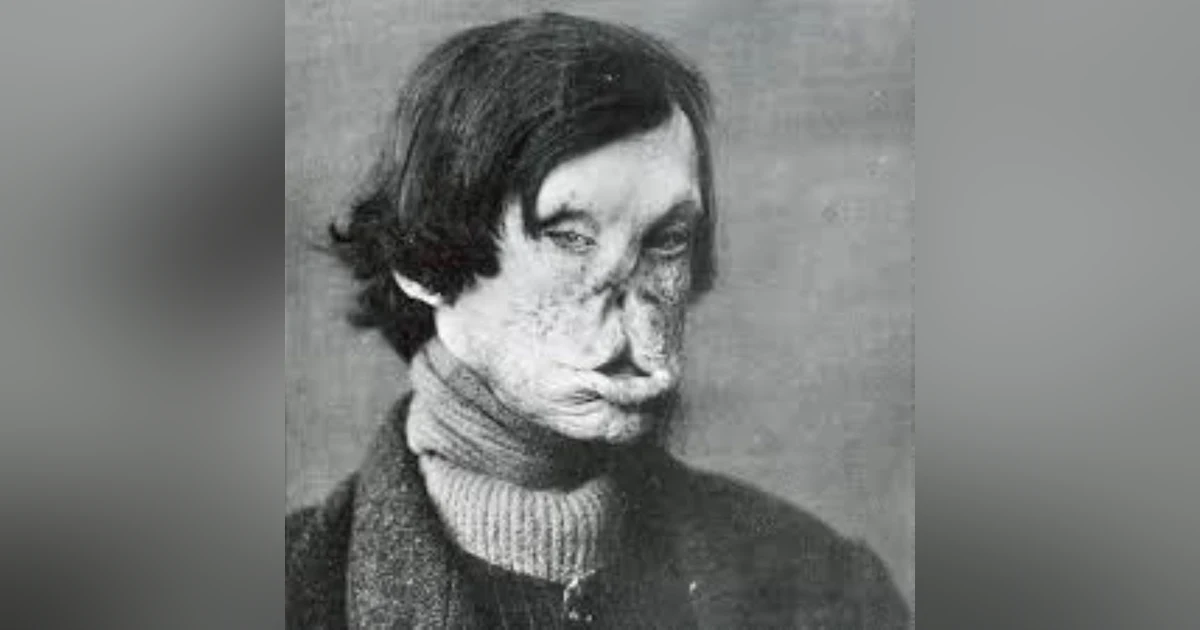 S4 E2: Oh, Holy Stigma: The Story of Leprosy