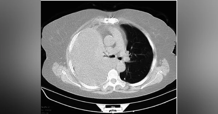 image for Small-bore vs Large-bore Chest Tubes in Hemothorax