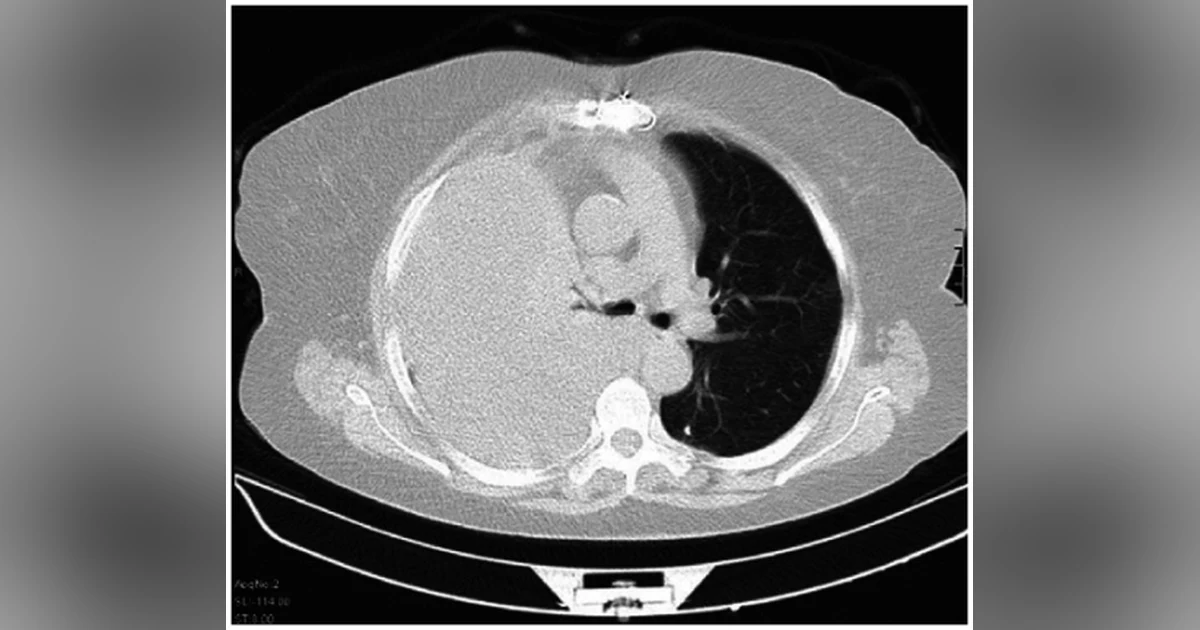 Journal Club: Small-bore vs Large-bore Chest Tube for Hemothorax