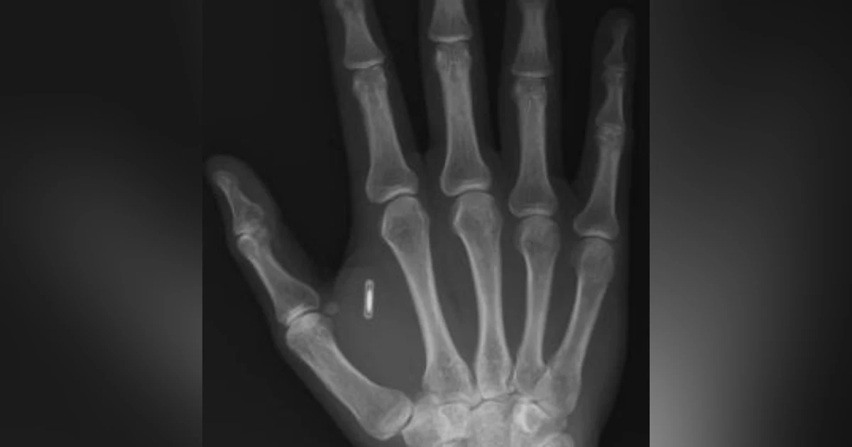 The Invisible Crime: Illegal Microchip Implants and Microwave Technology