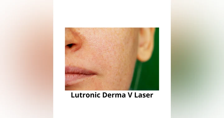 image for Lutronic Derma V Laser Explained: Uses, Technology & Clinical Insight with Dr. James Wang