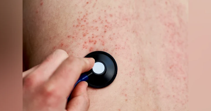 image for The History of Measles: From Cattle Plague to Human Threat