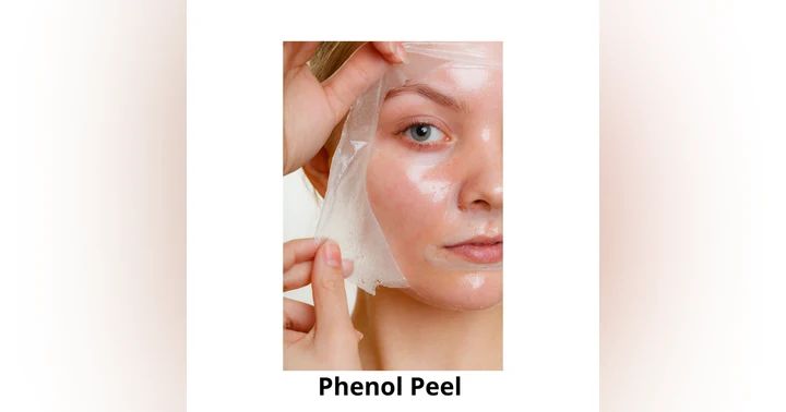 image for What Is a Phenol Peel? Benefits, Risks, Recovery, and Who It’s Really For