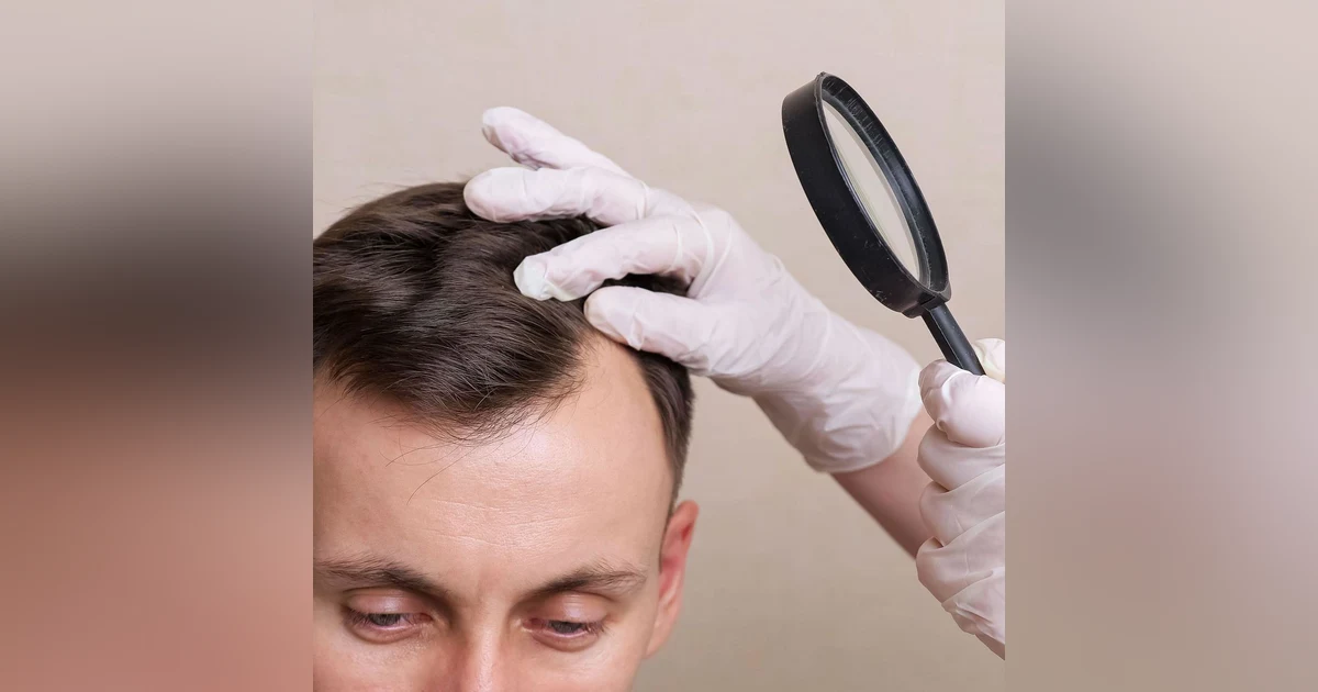 Las noticias de Herrero: Terapia con células madre: más cerca del fin de la alopecia