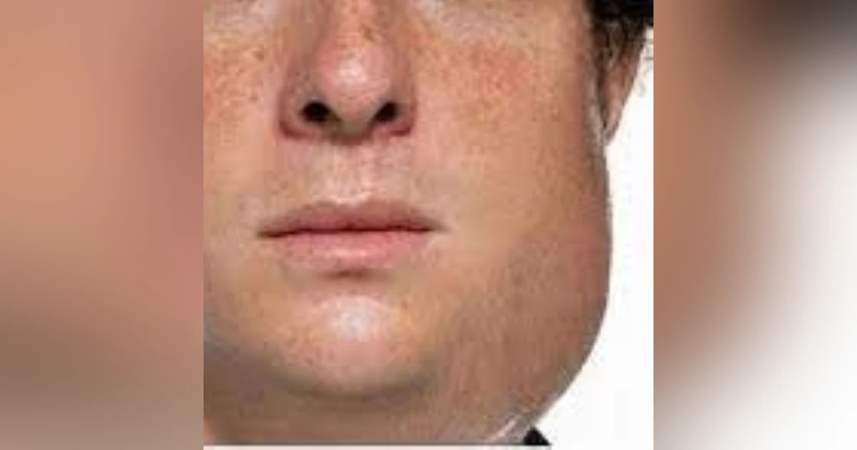 S3E9: Earache My Eye: The Story of Mumps