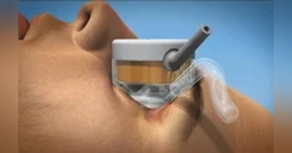 Ep 22 Talking About Glaucoma - 6Feb2014: HiFU Therapy (mp3 version)