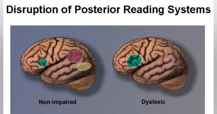 image for Understanding Dyslexia: Insights from Russell Van Brocklen
