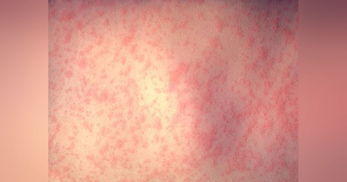 Why We Vaccinate Against Measles