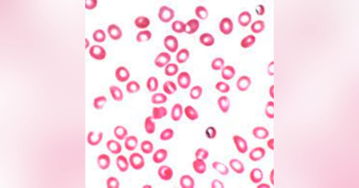 S3 E2: More Than You Ever Wanted to Know: Microcytic Hypochromic Anemia: The Christmas Episode